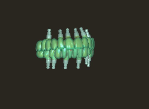Tehnologia CAD-CAM la Green Dental Lab