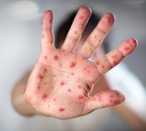 SEMNAL DE ALARMĂ DE LA MEDICI: Rujeola face prăpăd, chiar dacă e cald afară, persoanele cu imunitate scăzută fac mari complicații SEMNAL DE ALARMĂ DE LA MEDICI: Rujeola face prăpăd, chiar dacă e cald afară, persoanele cu imunitate scăzută fac mari complicații